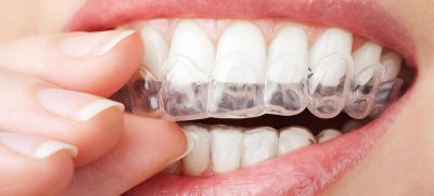 nakładkowy sposób wybielania zębów